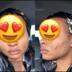 Bright Skin Tea Tree Acne Set