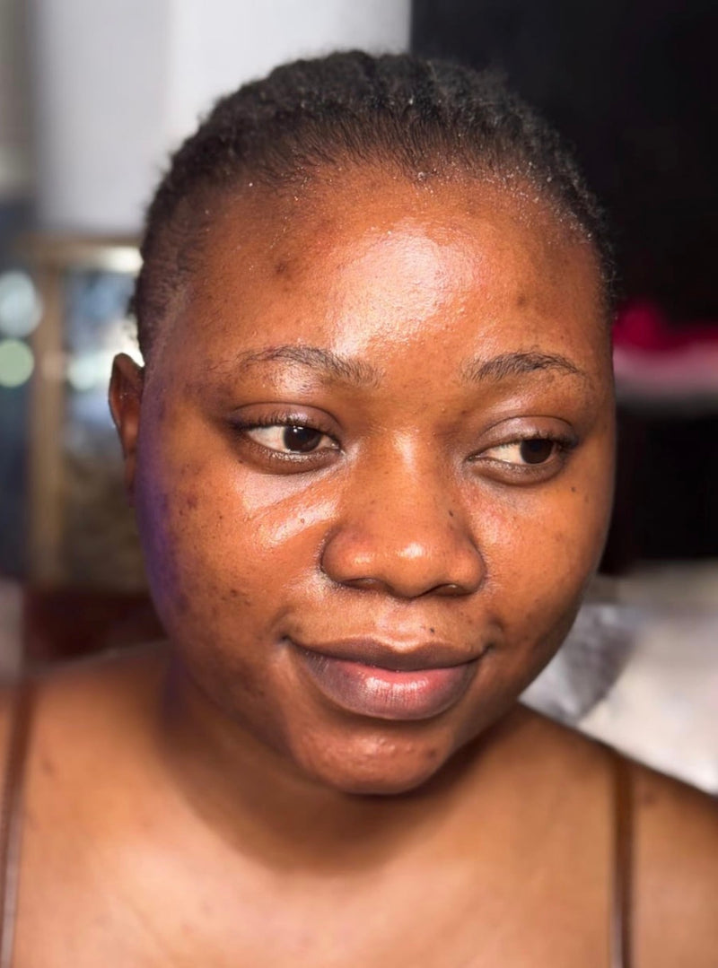 Dark Spots & Acne Scars